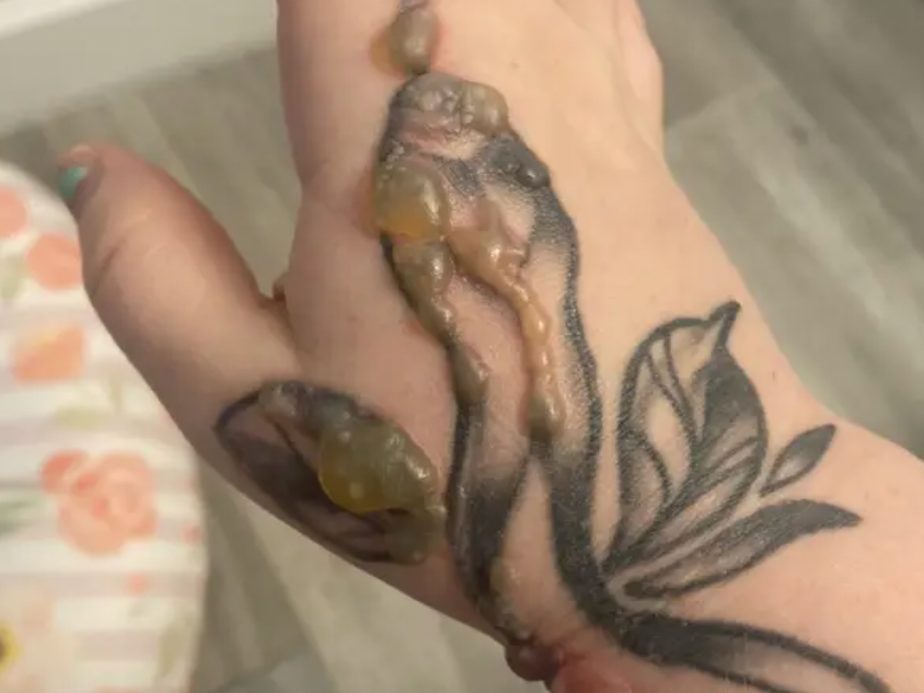 Woman horrified after warts grew on tattoo and had to be burned off